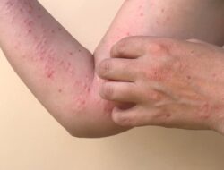 Kasus Monkeypox di Indonesia Bertambah