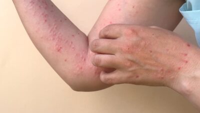 Kasus konfirmasi cacar monyet atau Monkeypox