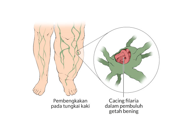 Antisipasi Penyakit Filariasis, Seluruh Petugas Dinkes Aceh Jaya Konsumsi Obat Kaki Gajah 3 kaki-gajah